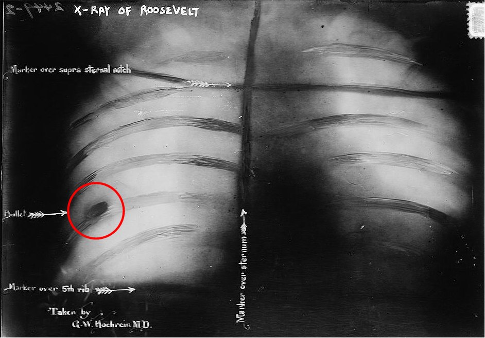 X-Ray of bullet in Roosevelt's chest