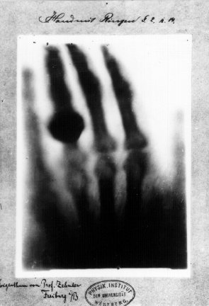 Roentgen's wife's hand