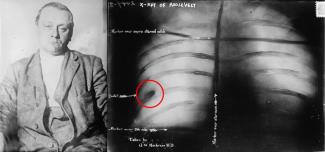 John Schrank and X-Ray of bullet in Roosevelt's chest