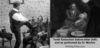 First Successful Tooth Extraction Using Anesthesia